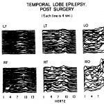1974 Technical Paper: GEVINS_INTERACTIVE ANALYSIS AND DISPLAY OF THE ELECTROENCEPHALOGRAM (EEG) IN REAL TIME