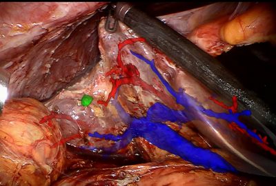 2015 Posters: Marques_Improving Depth Perception during Surgical Augmented Reality