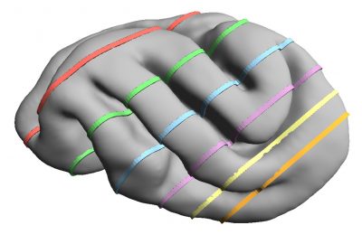 2015 Posters: Holloway_Contour Guided Surface Deformation For Volumetric Segmentation