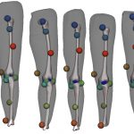 Estimating Skeleton from Skin Data for Designing Subject-Specific Knee Braces