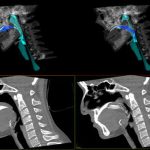 3D Dynamic Visualization of Swallowing from Multi-Slice Computed Tomography