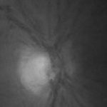 Selective Visualization of Anomalies in Fundus Images via Sparse and Low Rank Decomposition