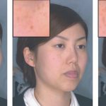 Real-time image-based control of skin melanin texture