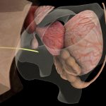 Interactive simulation of surgical needle insertion and steering