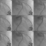 Time-dependent three-dimensional intravascular ultrasound
