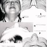 Three dimensional computer graphics for craniofacial surgical planning and evaluation
