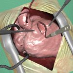 Technical aspects of the GPU accelerated surgical simulator