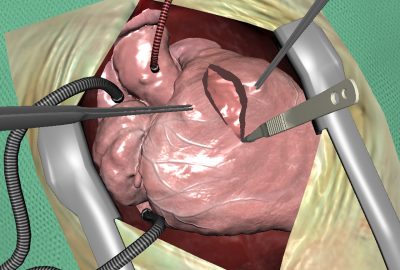 2006 Talks: Mosegaard_Technical Aspects of the GPU Accelerated Surgical Simulator