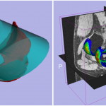 Flattened anatomy for interactive segmentation & measurement