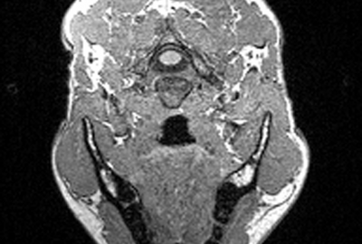 2009 Posters Yarimizu Muscle based Facial Animation Considering Fat Layer Structure Captured by MRI 03