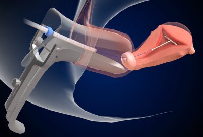 2024 Talks: Doolittle_Real-time 3D Graphics for Health Impact Interactive 3D IUD Insertion