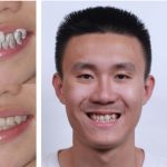 2020 SA Technical Papers_Yang_iOrthoPredictor: model-guided deep prediction of teeth alignment