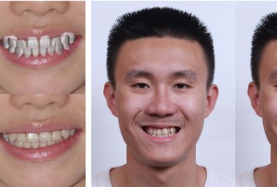 2020 SA Technical Papers_Yang_iOrthoPredictor: model-guided deep prediction of teeth alignment